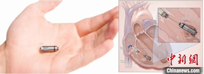 湖南一医院成功为一例患者植入胶囊无导线起搏器
